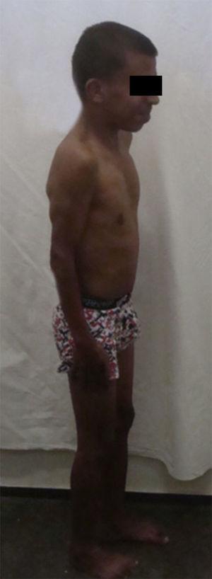 Patient with Noonan's syndrome (short stature, short neck, and chest deformity).