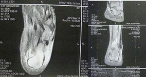 MRI of the ankle with edema in the posterior region of the calcaneus, thickening and increased density in the insertion of the left Achilles tendon, partial rupture associated to peritendinitis and retrocalcaneal bursitis.