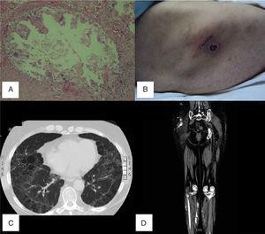 (A) Skin biopsy of gluteal region with foreign body granuloma with calcifications, vascular proliferation, necrosis and areas of sclerosis. (B) Superficial skin necrosis, gluteal region, right side view. (C) Plain chest CT-AR, panlobular emphysema. (D) Lower limb CT, with confluent hyperdense nodular lesions in both buttocks that spread to the thigh and posterior leg region suggesting calcifications.