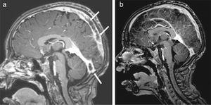 (a) Magnetic resonance imaging of brain before the infliximab. Hyperintense thrombosis filling the superior sagittal sinus and proximal segments of both transverse sinuses was showed and (b) after second dose of infliximab, significant dissolution of the thrombosis was observed in the brain MRI.