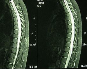 MRI in T2 sequence with large segment myelitis in the dorsal spinal cord, from D5 to D12. Widening with medullary hyperintense signal, consistent with the underlying disease.