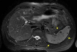 Abdominal MIR with gadolinium center in T2 showing splenic lesions (arrows).
