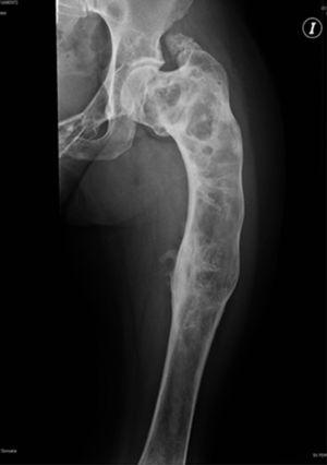 Anteroposterior X-ray of the left femur with a «shepherd's staff » deformity, a thin cortex and expansive radiolucent images.