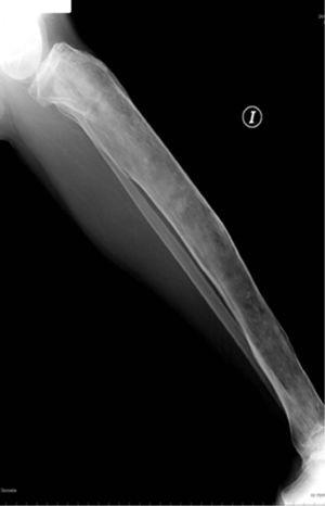 Radiographie latérale du tibia gauche, qui est incurvé et présente une corticale fine.