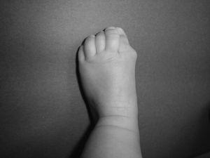 Dysplasia of the first metatarsal in hallux valgus deformity is the most characteristic feature of the FOP. Proper identification from birth is of great diagnostic importance and avoids potentially harmful procedures.