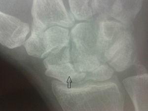 Right hand X-ray showing scaphoid collapse, with signs of osteoarthritis (arrow).