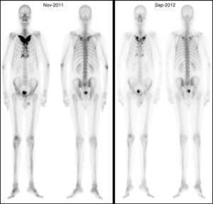 Tc99 bone scan where the favorable outcome after treatment is shown.