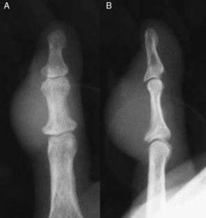 単純なX線AP（A）および側方突起（B）、病変に対応する密度の増加、指節軟部組織の補償を伴う。