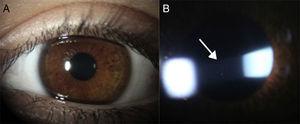 (A) Eye with chronic anterior uveitis associated with JIA without showing evidence of inflammation upon superficial examination. (B) Same eye under slit lamp examination showing Tyndall phenomenon (protein exudation) and inflammatory cells (arrow) floating in the aqueous humor of the anterior chamber.