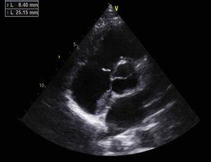 Apical 5-chamber echocardiogram view showing a thrombus in the right atrium.