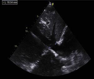 Subcostal echocardiogram view showing a thrombus in the inferior vena cava.