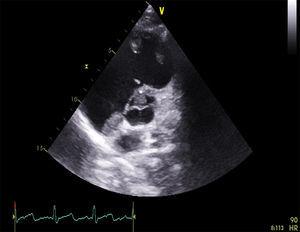 Apical 5-chamber echocardiogram view showing thrombi in the right ventricle.