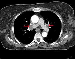 Torax computed tomography showed bilateral hilar and mediastinal lymphadenopaties.
