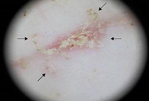 Dermatoscopic image showing brownish structures, in the form of a “hang glider” at the end of the burrows (arrows).