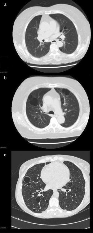 High-resolution computed tomographic study: (a) image showing centrilobular emphysema and cysts; (b) bilateral cystic lung lesions, some with septa in their interior, traction bronchiectasis in both lower lobes, areas of centrilobular and paraseptal emphysema and zones of fibrotic tissue; and (c) image showing multiple bilateral thin-walled pulmonary cysts.