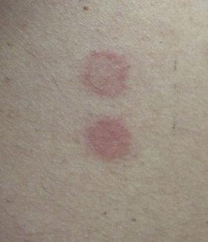 Positive patch tests 72h after exposure to methylisothiazolinone (top) and ultrasound gel (bottom).