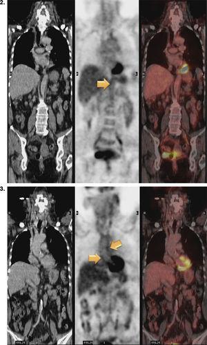 Positron emission tomography/computed tomography images with 18F-fluorodeoxyglucose (FDG) showing abnormal FDG uptake along the wall of thoracic and abdominal artery. Involvement of aortic arch, descending thoracic aorta and pulmonary artery can be seen. Increased FDG uptake is observed along the entire length of abdominal aorta, affecting superior mesenteric artery and extending to the common iliac bifurcation. Foci of calcified atheromatosis are present.