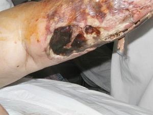 Necrotic eschar on patient's left leg.