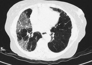 HRCT. Patchy involvement in ground glass opacity in right lung tending to fibrosis due to NSIP.