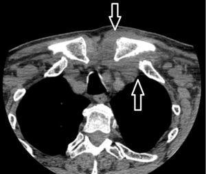 Augmentation of soft tissue and obliteration of fat planes associated with the inflammatory-infectious process in left sternoclavicular joint (arrows).