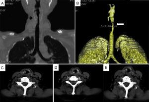 Laryngotracheal computed tomography in patient no. 2. (A) Subglottic stenosis (arrow). (B) 3D reconstruction of subglottic stenosis (arrow). (C)–(E) Axial images showing a granulomatous lesion (*) partially obstructing the tracheal lumen.