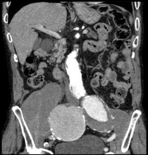 Abdominopelvic computed tomography. Coronal plane. Large isolated, bilateral iliac aneurysms.