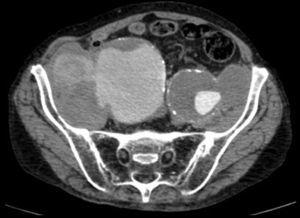 Computed tomography. Axial plane. Contained rupture of aneurysm of right common iliac artery. Extra-adventitial hematoma with signs of organization in its wall, which borders on neighboring structures. The hematoma shows continuity with the lumen, in the form of a pseudoaneurysm.