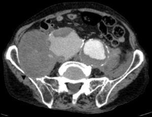 Computed tomography of pelvis. Perforated right iliac bone (arrowhead).