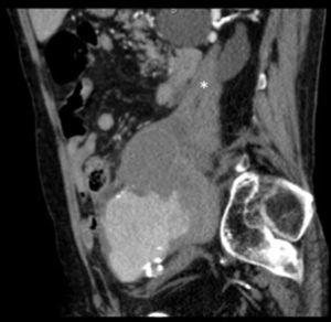 Abdominopelvic computed tomography. Sagittal plane. Hematoma that has become chronic, located in the space of the psoas muscle (asterisk).