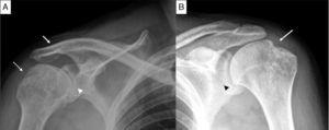 Anteroposterior projection of shoulders. (A) The view of right shoulder shows erosions in the greater tuberosity (dashed arrow), narrowing of the glenohumeral joint space (arrowhead) and ankylosis of the acromioclavicular joint (arrow). (B) The view of left shoulder shows narrowing of the glenohumeral joint space (arrowhead) and the hatchet sign (arrow).