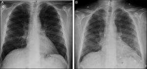 (A) Anteroposterior chest radiograph showing a faint bilateral interstitial line. (B) Anteroposterior chest radiograph 2 days later showing a diffuse density in the region of the hilum and lung bases, and imaging of segmental atelectasis in the middle field.