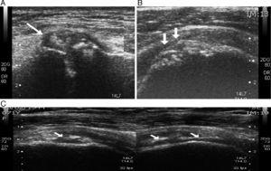 (A) Joint effusion and calcifications in the acromioclavicular joint. (B) Calcifications of the humeral cartilage (chondrocalcinosis). (C) Subchondral erosions and subacute-chronic rupture of the anterior portion of the supraspinatus tendinopathy (tendinous weight loss due to compression).