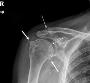 Osteophytosis of the humeral head in relation to degenerative changes in the glenohumeral joint (thick arrows). Calcification of the acromioclavicular joint and humeral cartilage (thin arrows). No tendinous calcifications or subacromial impingement are observed.