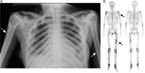 (A) Anteroposterior chest radiography showing the irregular thickening of the diaphyseal cortical bone of the long bones, especially in both humeri. This bilateral and symmetrical cortical thickening is also evident in the clavicles, greater in the medial area. (B) Whole body bone scintigraphy in anterior and posterior images, showing multiple abnormal uptakes of 99mTc-diphosphonates with different uptake intensity, in relation to the osteoblastic activity, which is more evident in diaphyseal regions of the long bones and left hip.