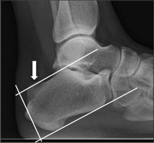 Haglund's Syndrome. Two Case Reports | Reumatología Clínica