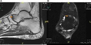 (A) Sagittal magnetic resonance imaging (MRI) in T1-weighted sequence, showing the focal lesion at the level of the talar head with diffuse edema in other bones of right foot. (B) Axial MRI of the foot in T2-weighted sequence, with fat saturation, showing focal lesion at level of the talar head and joint effusion at the level of anterior and posterior tibiotalar joint of right foot.