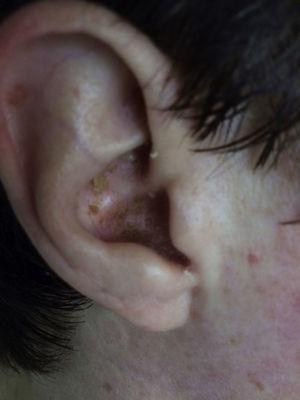 Pustular lesion on right outer ear.