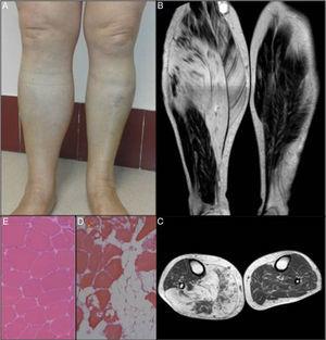 (A) Increase in the volume of right leg. (B, C) Longitudinal and cross-sectional magnetic resonance imaging of both lower limbs. (D) Muscle biopsy of the patient reported here (hematoxylin–eosin 10×). (E) For comparison, a normal muscle biopsy of medial gastrocnemius (10×).
