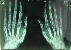 Bone demineralization in left carpus and hand.