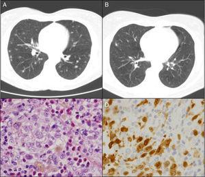 (A) Pulmonary computed tomography (CT) at the time of diagnosis. (B) Pulmonary CT 6 months after the patient had quit smoking. (C) Langerhans cells (hematoxylin–eosin). (D) Positive immunohistochemical technique for CD1a (100×).