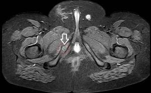 Axial magnetic resonance imaging (short tau inversion recovery) of pelvis: swelling of right ischiopubic synchondrosis, with irregular margins. Signal alteration in bone marrow and edema of the surrounding soft tissue.