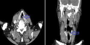 On the left side, a cross-sectional slice of a cervical CT showing the paramedial position of the left vocal cord (arrow). On the right side, an axial slice showing the same position of the vocal cord (arrow), findings compatible with paralysis.