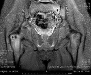 Magnetic resonance image revealing bone marrow edema indicative of left-sided sacroiliitis (*) and osteitis of right proximal femur (**).