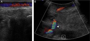 Eco-Doppler: bypass control. (A) Superficial pathway of the in situ SVG. (B) Permeable bypass (arrow head). Femoral condyle (asterisk).