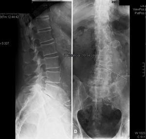 Anteroposterior and lateral radiographs of the lumbar spine. They show aneurysmatic dilation of the abdominal aorta labeled with a line that measures its transverse axis.