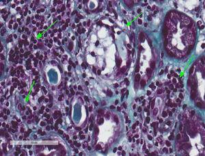 Tubulointerstitial nephritis and a mild case of secondary acute tubular necrosis. Kidney biopsy. Lymphocytary inflammatory infiltration which mainly affects the insterstitium and lymphocyte permeation in the tubular epithelium with partial destruction of it, compatible with TIN. Few tubules present regenerative changes with flat epithelium and cytoplasmatic vacuolisation with nuclei enhanced in size and hyperchromatic and with intraluminal epithelial desquamation (secondary acute tubular necrosis) (Masson's trichrome, 40×).