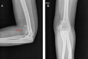 Plain X-ray of left elbow in lateral projection (A) and anteroposterior (B) projection.