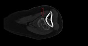 Noncontrast iv CT image of the left elbow. Both radiology studies show a calcified mass with a sclerotic surface not dependent upon on the radial cortex (arrows).