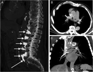 (A) CT sagittal view where one may observe the cement material in the 5 vertebral bodies (short arrows). Note the presence of a cement leakage from the fifth vertebra towards the right common iliac vein (long arrow); this leakage is probably responsible for the cement emboli in the pulmonary arteries. (B and C) Axial (B) and coronal (C) images of CT (maximum intensity projection) with very high density lineal repletion defected (arrows) in the lumen of the main pulmonary arteries and which represent the cement material.