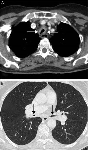 (A) CT axial view where a noticeable thickening of the tracheal walls (arrows) may be observed, together with highly significant reduction in their lumens. (B) CT axial view (lung imaging window) where major circumferential thickening of the walls of both main bronchi may also be observed, together with serious reduction in their lumen quality (arrows).